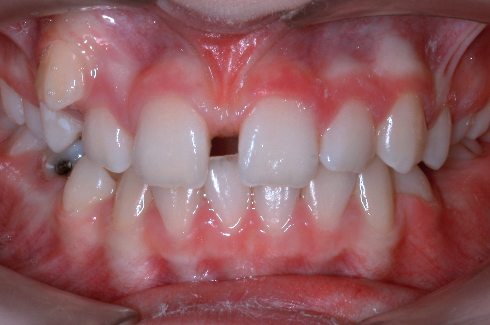 Nedostatek místa na špičák posunem řezáků doprava, mezera mezi středními řezáky (diastema), hluboký skus